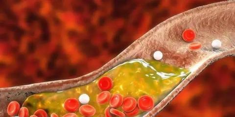 超聲造影告訴你：你的頸動(dòng)脈斑塊“穩(wěn)定”嗎？