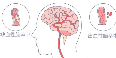牢記兩大口訣，盡早識別急性腦血管疾病——“腦卒中”