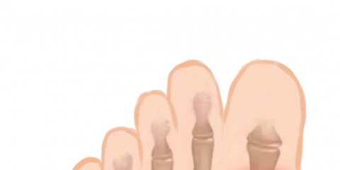 避雷！這六大痛風(fēng)的誤區(qū)別再犯了！